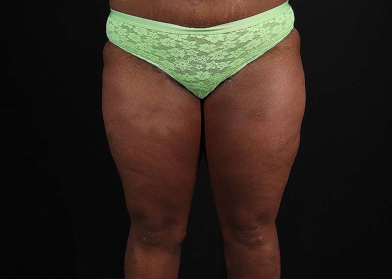 Thigh Lift Before & After Patient #3122
