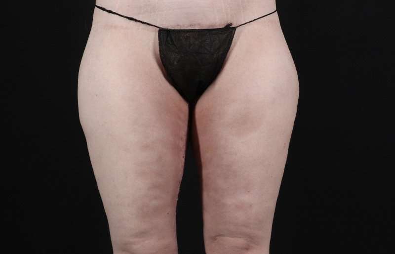 Thigh Lift Before & After Patient #3135