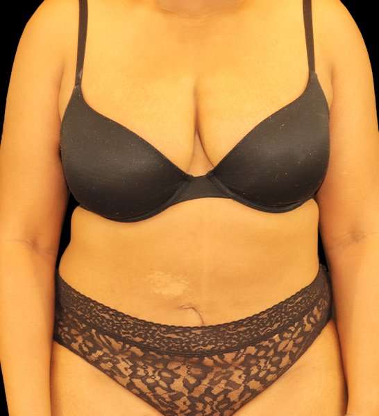 Tummy Tuck Revision Before & After Patient #3146
