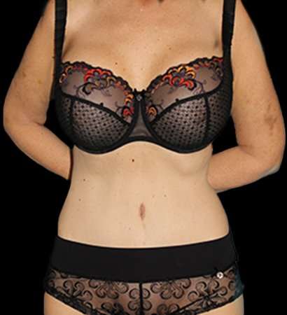 Tummy Tuck Revision Before & After Patient #3168