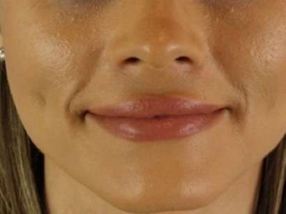 Lip Augmentation - Fat Grafting Before & After Patient #3210