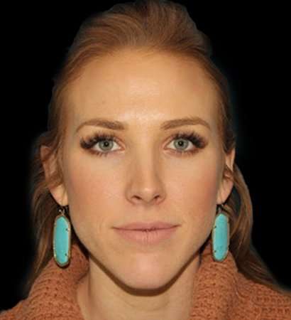 Botox Before & After Patient #3217