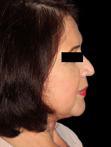 Face & Neck Lift Before & After Patient #3248