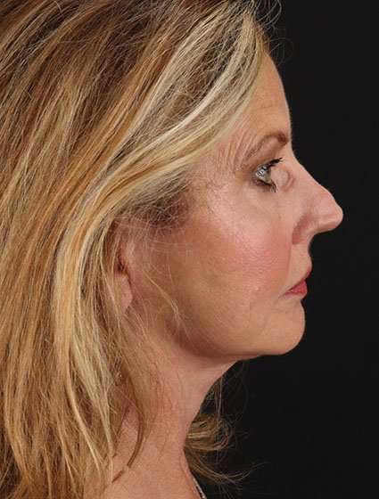 Face & Neck Lift Before & After Patient #3259