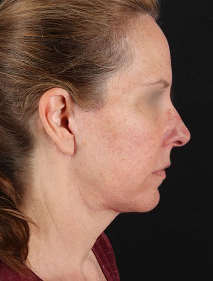 Face & Neck Lift Before & After Patient #3270
