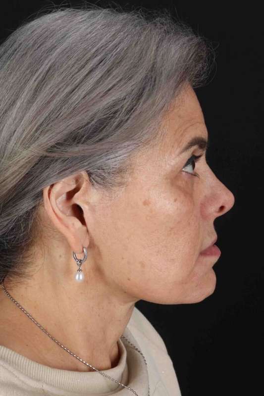 Face & Neck Lift Before & After Patient #3292