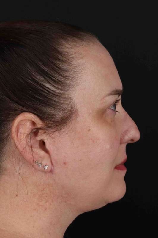 Face & Neck Lift Before & After Patient #3303