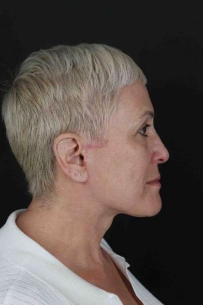 Face & Neck Lift Before & After Patient #3314