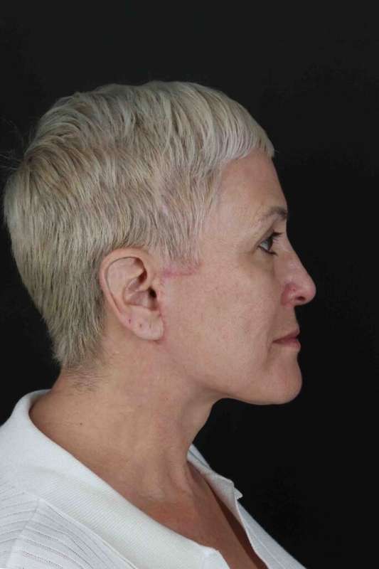 Face & Neck Lift Before & After Patient #3314