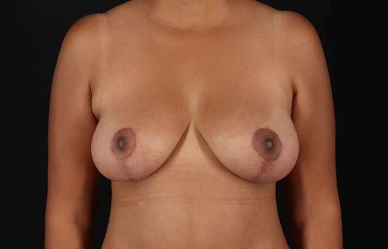 Breast Lift Before & After Patient #1149