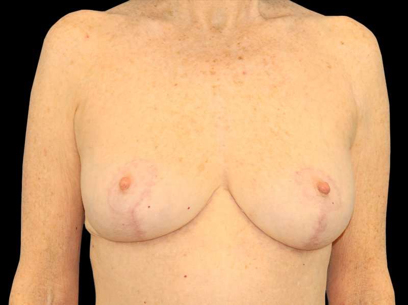 Breast Reduction Before & After Patient #1239