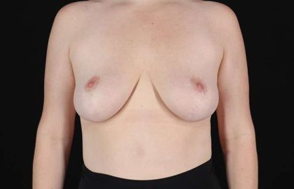 Breast Reduction Before & After Patient #1250