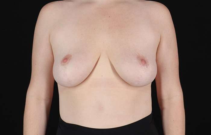 Breast Reduction Before & After Patient #1250