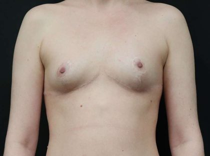 Breast Reduction Before & After Patient #1261