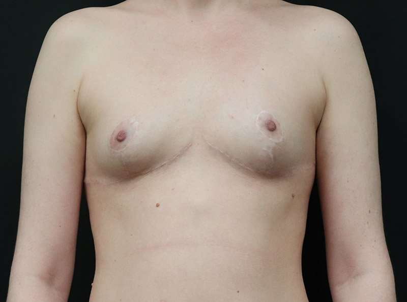 Breast Reduction Before & After Patient #1261