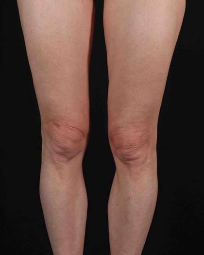 Quantum Rf Before & After Patient #925
