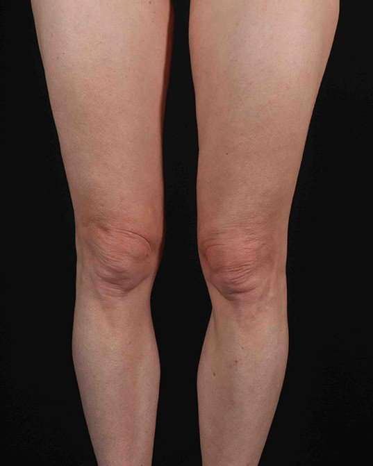 Quantum Rf Before & After Patient #925