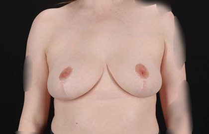 Breast Reduction Before & After Patient #1305