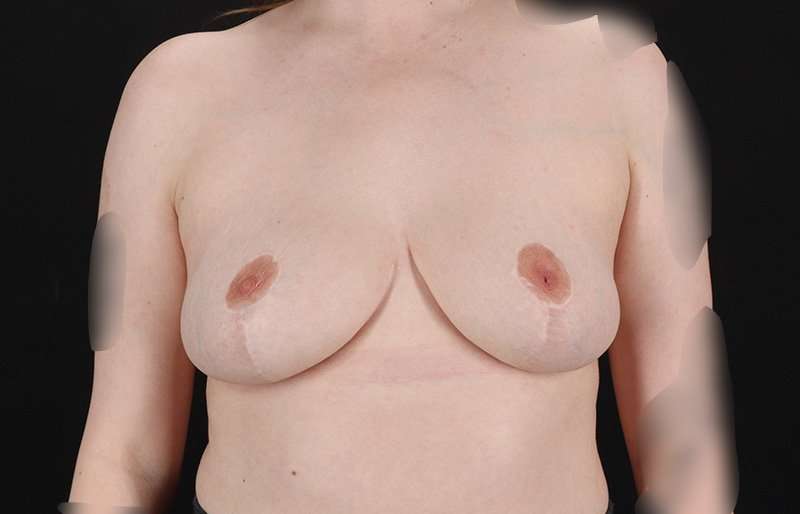 Breast Reduction Before & After Patient #1305