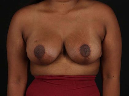 Breast Lift Before & After Patient #1343