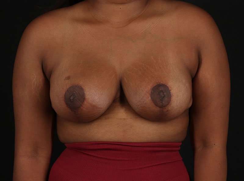 Breast Lift Before & After Patient #1343
