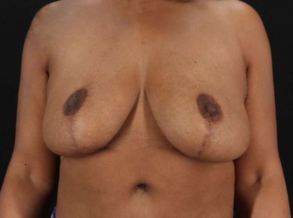 Breast Reduction Before & After Patient #1387