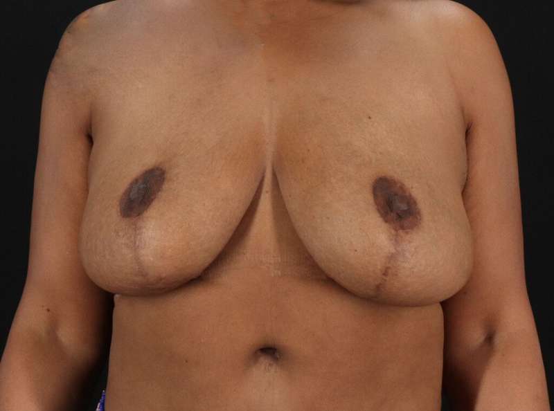 Breast Reduction Before & After Patient #1387