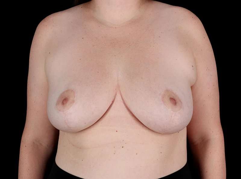 Breast Reduction Before & After Patient #1409