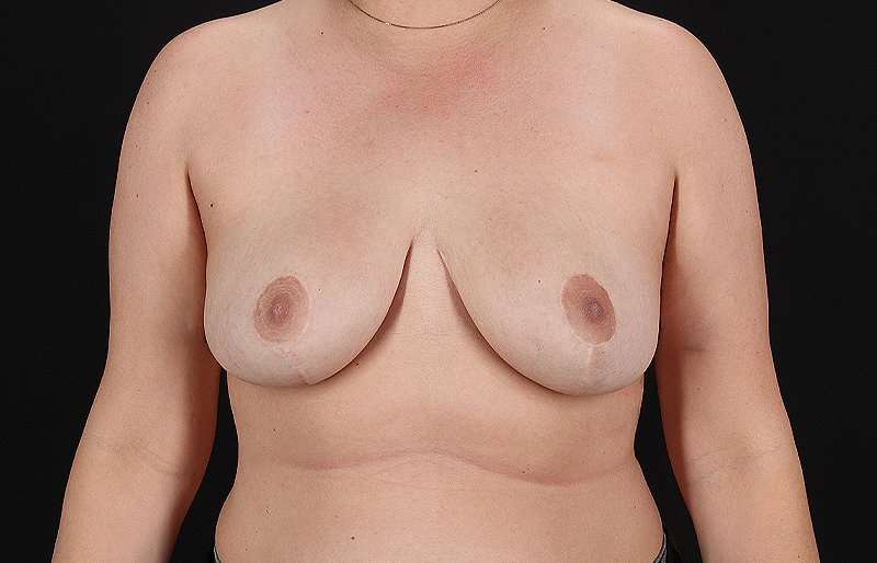 Breast Reduction Before & After Patient #1420