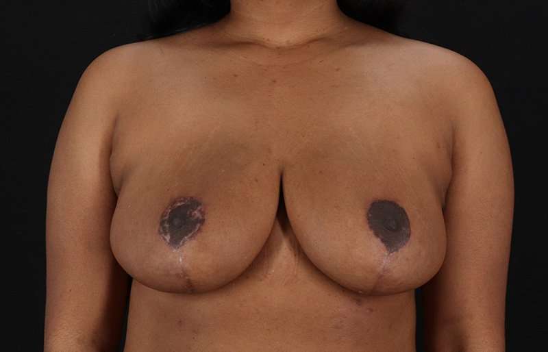 Breast Reduction Before & After Patient #1431