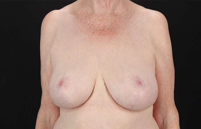 Breast Reduction Before & After Patient #1442