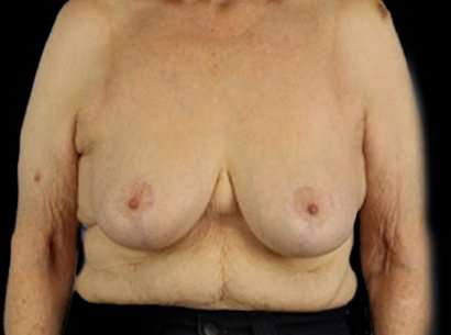 Breast Reduction Before & After Patient #1464