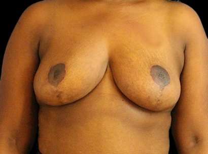 Breast Reduction Before & After Patient #1475