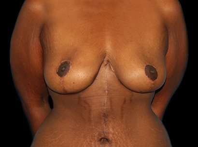 Breast Reduction Before & After Patient #1486
