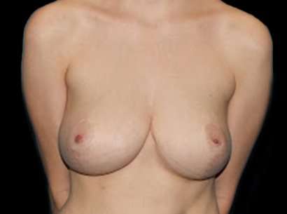 Breast Reduction Before & After Patient #1493