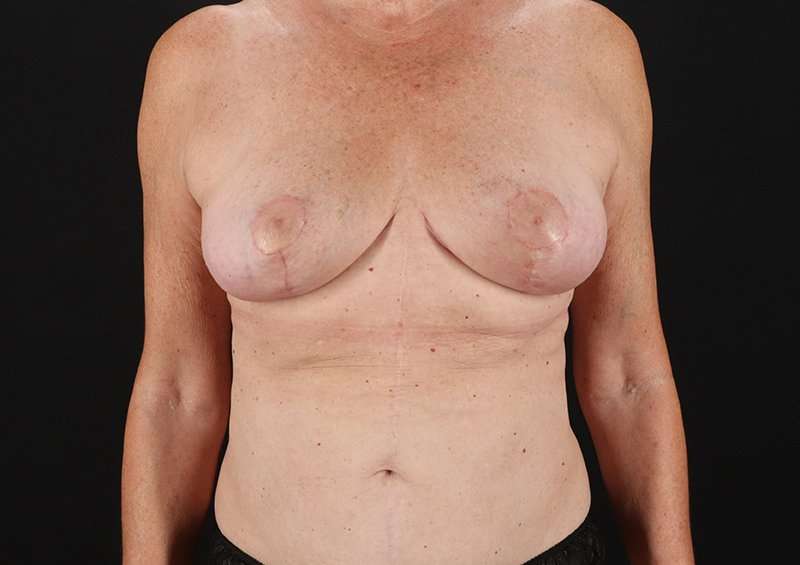 Augmentation/Lift Before & After Patient #1504