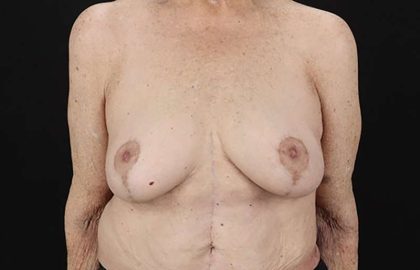 Augmentation/Lift Before & After Patient #1544