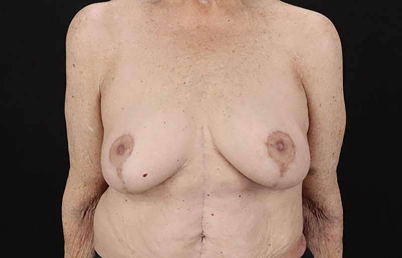 Augmentation/Lift Before & After Patient #1544