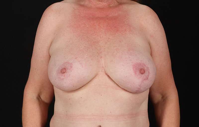 Breast Augmentation - Fat Transfer Before & After Patient #1557