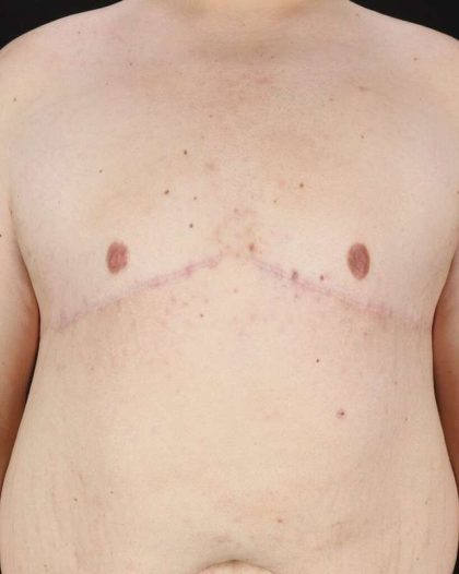 Gynecomastia Before & After Patient #1603