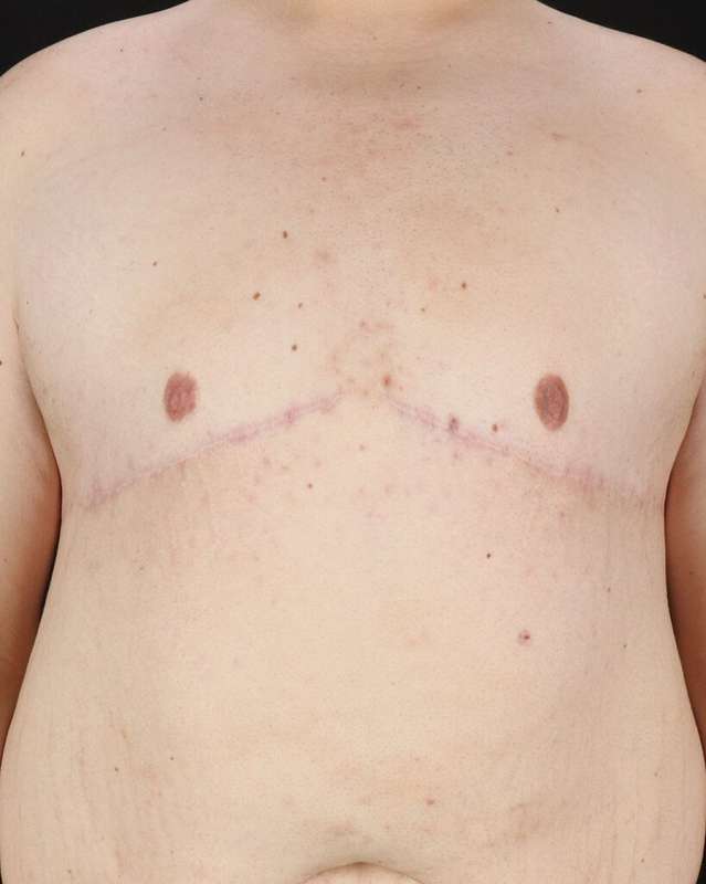 Gynecomastia Before & After Patient #1603