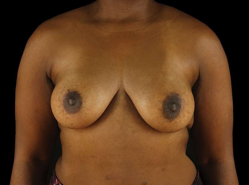Breast Augmentation - Implant Before & After Patient #954