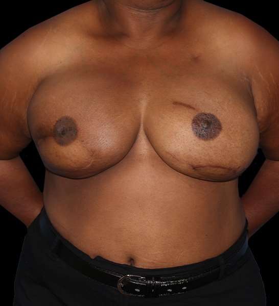 DIEP Flap Reconstruction Before & After Patient #1623