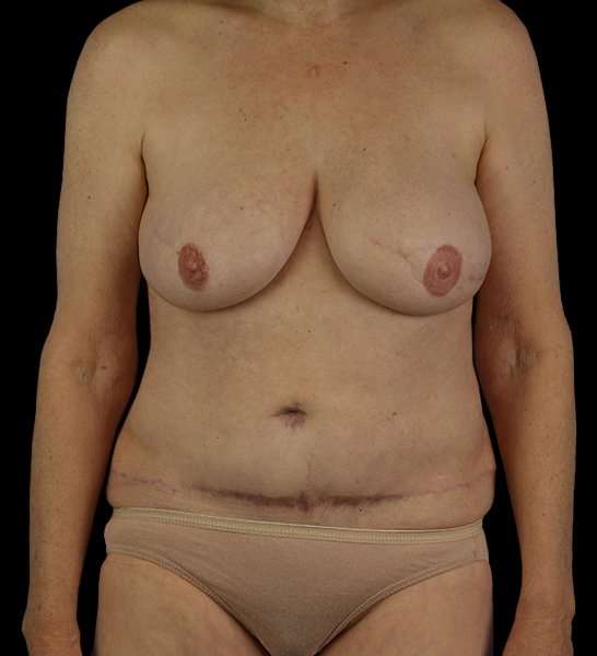DIEP Flap Reconstruction Before & After Patient #1634