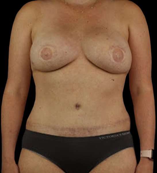 DIEP Flap Reconstruction Before & After Patient #1645
