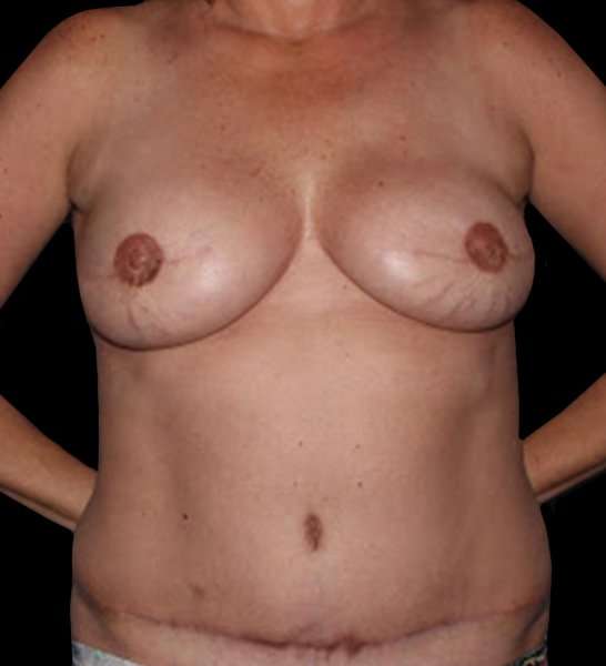 DIEP Flap Reconstruction Before & After Patient #1652
