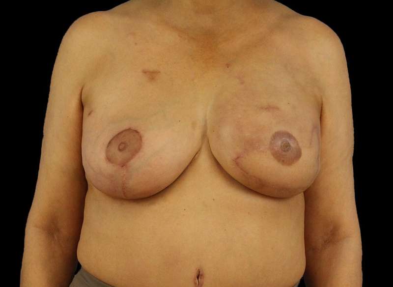 DIEP Flap Reconstruction Before & After Patient #1707