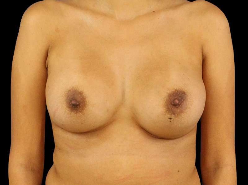 Breast Augmentation - Implant Before & After Patient #961