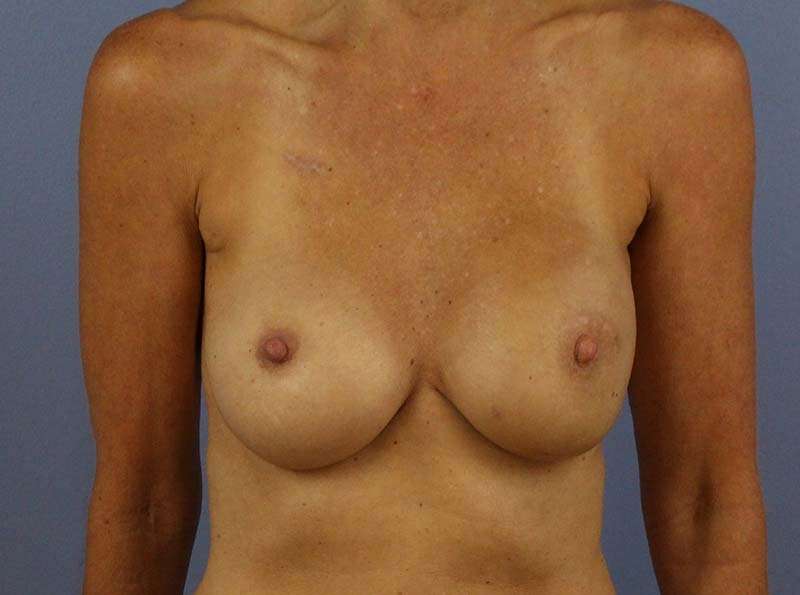 Implant Based Breast Reconstruction Before & After Patient #1729