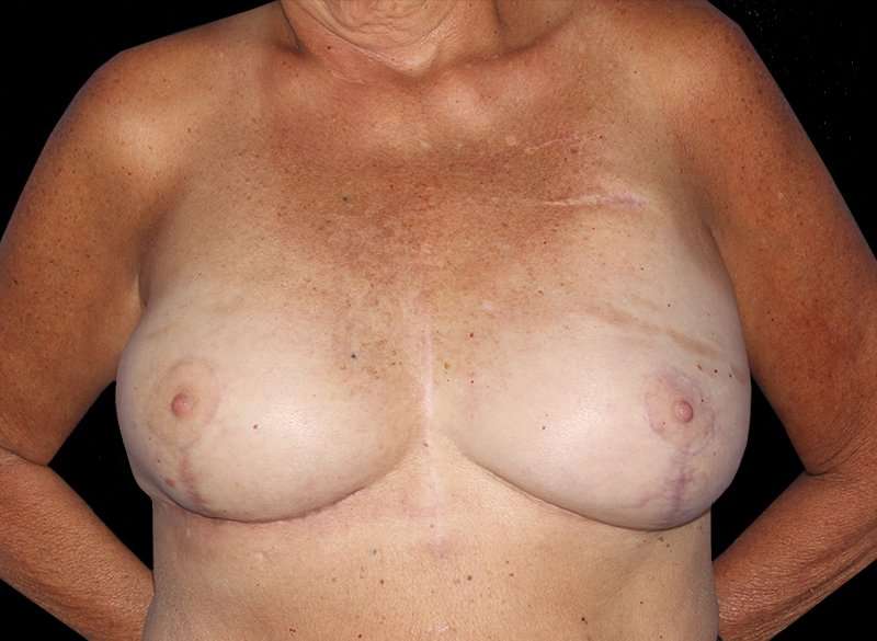 Oncoplastic Reconstruction Before & After Patient #1762